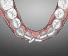 Long-term - Mandibular occlusal