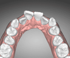 Long-term - Maxillary occlusal