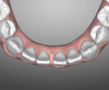 Mid-term - Mandibular occlusal