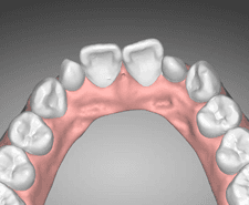 Mid-term - Maxillary occlusal