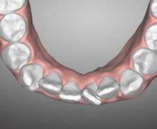 Long-term - Mandibular occlusal