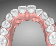 Long-term - Maxillary occlusal