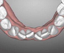 Mid-term - Mandibular occlusal