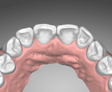 Mid-term - Maxillary occlusal