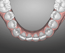 Short-term - Mandibular occlusal