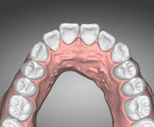 Short-term - Maxillary occlusal