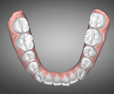 Long-term - Mandibular occlusal