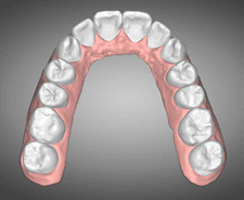 Long-term - Maxillary occlusal
