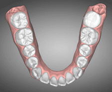 Mid-term - Mandibular occlusal