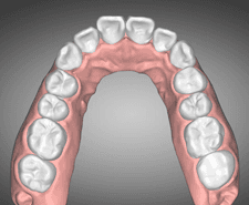 Mid-term - Maxillary occlusal