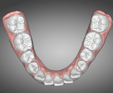 Long-term - Mandibular occlusal