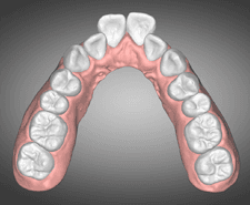 Long-term - Maxillary occlusal