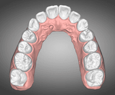 Mid-term - Maxillary occlusal