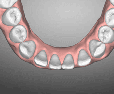 Long-term - Mandibular occlusal
