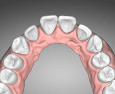 Long-term - Maxillary occlusal