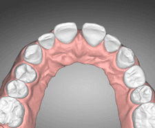 Mid-term - Maxillary occlusal