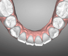 Short-term - Mandibular occlusal