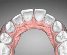 Short-term - Maxillary occlusal