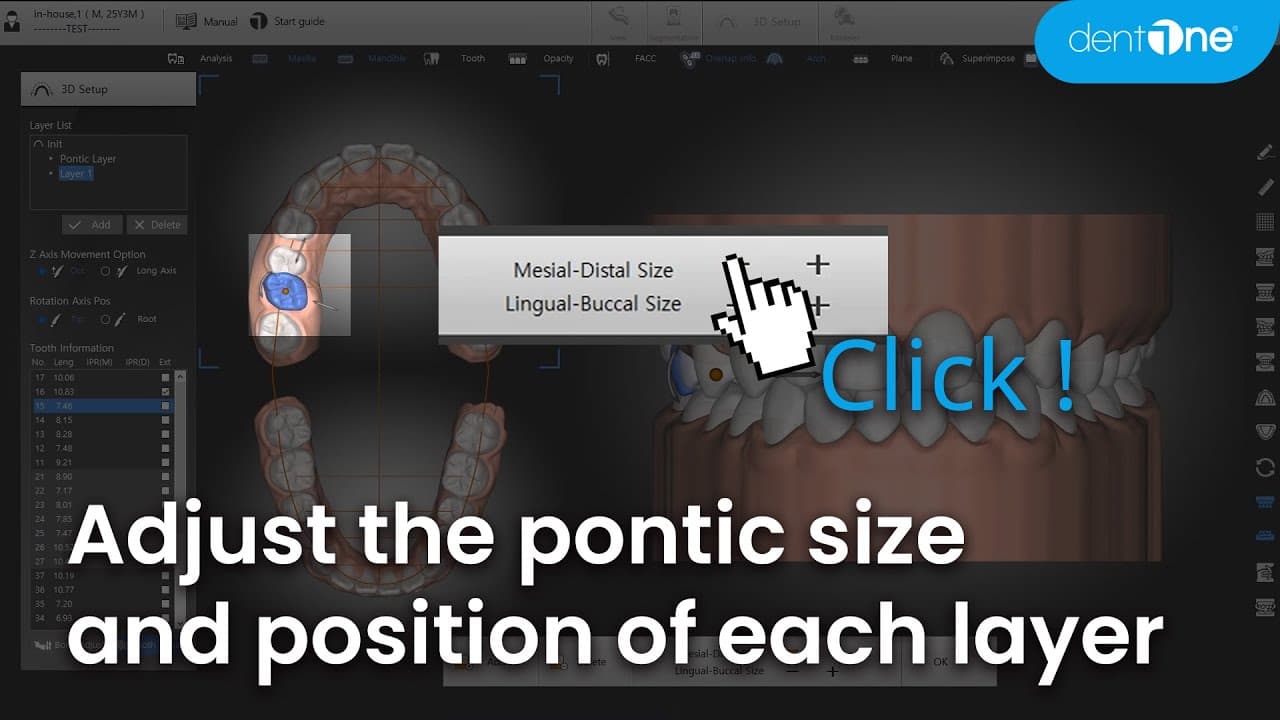 Adjust pontic size