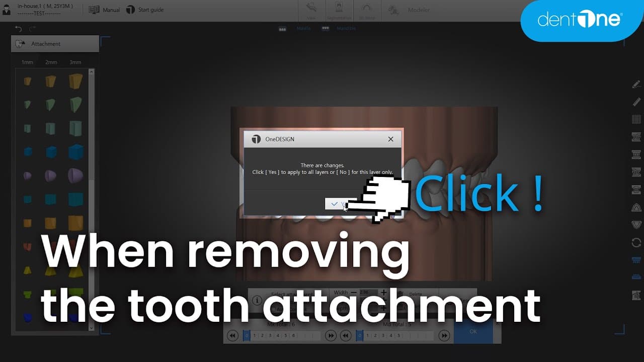 When removing the tooth attachment