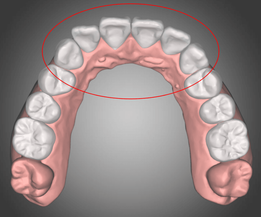 Crowded maxilla before IPR