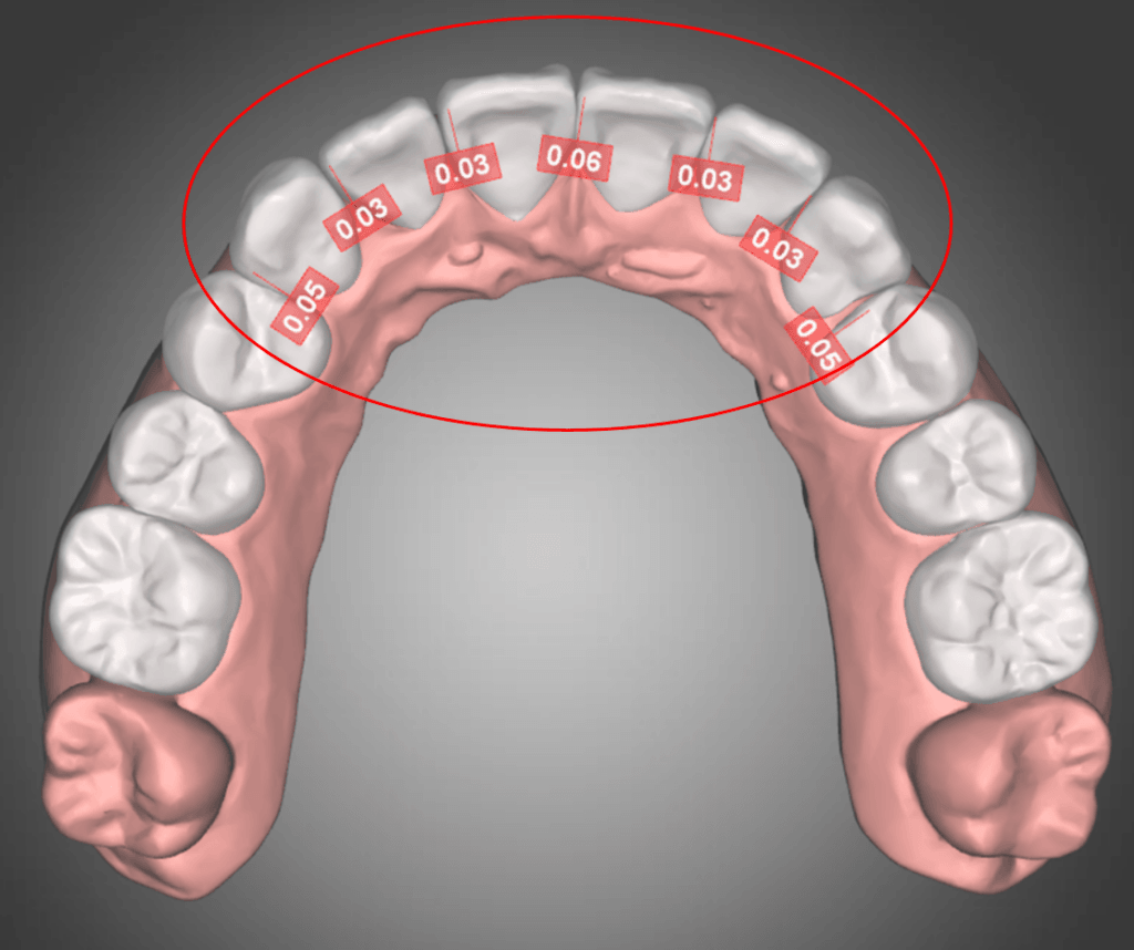 Maxilla with the IPR amount noted on each tooth