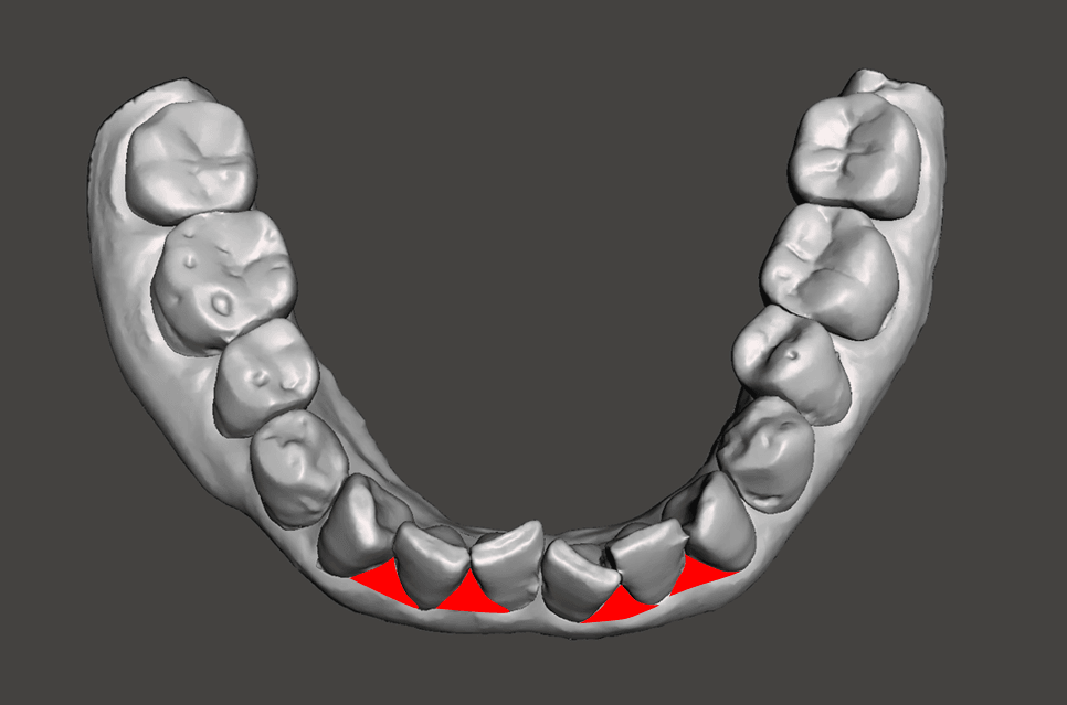 Model blocked out on teeth with many undercuts