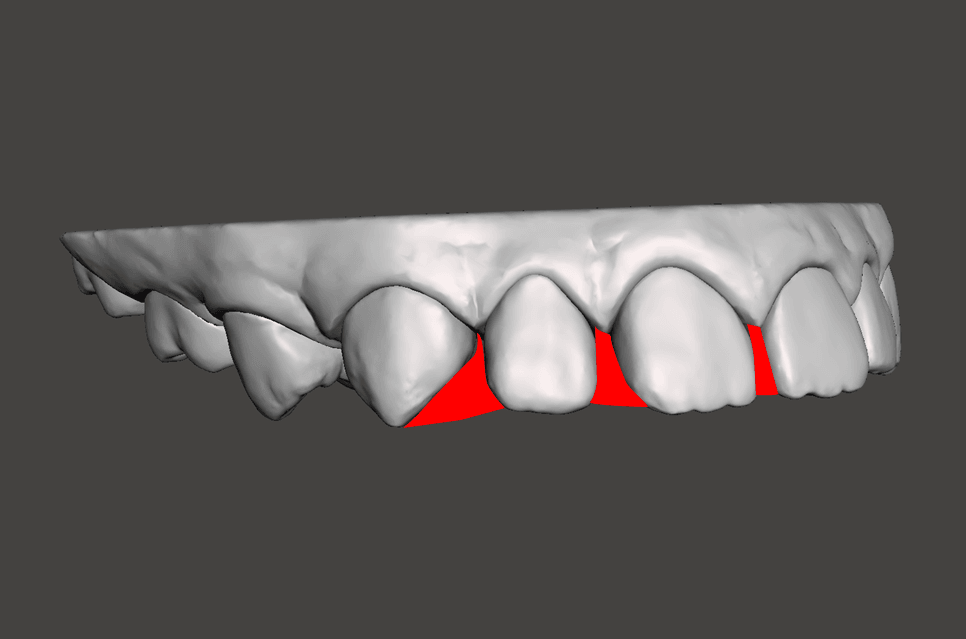 Model blocked out on the interdental space
