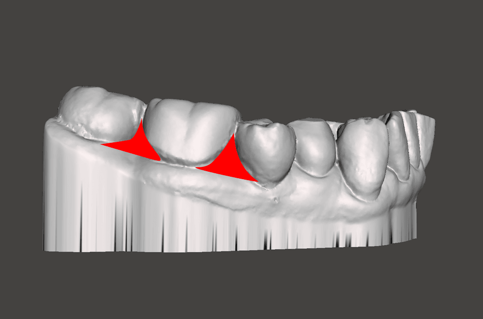Model blocked out on a missing tooth area