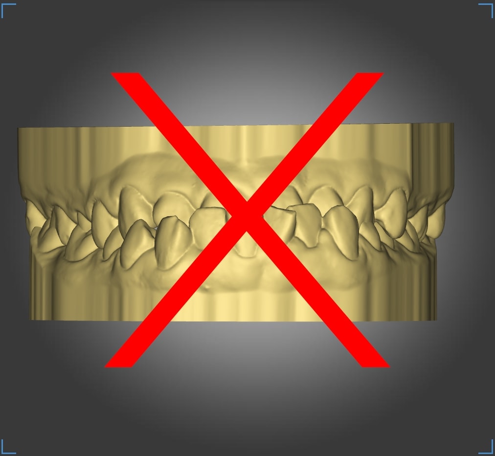 Incorrect occlusion 2