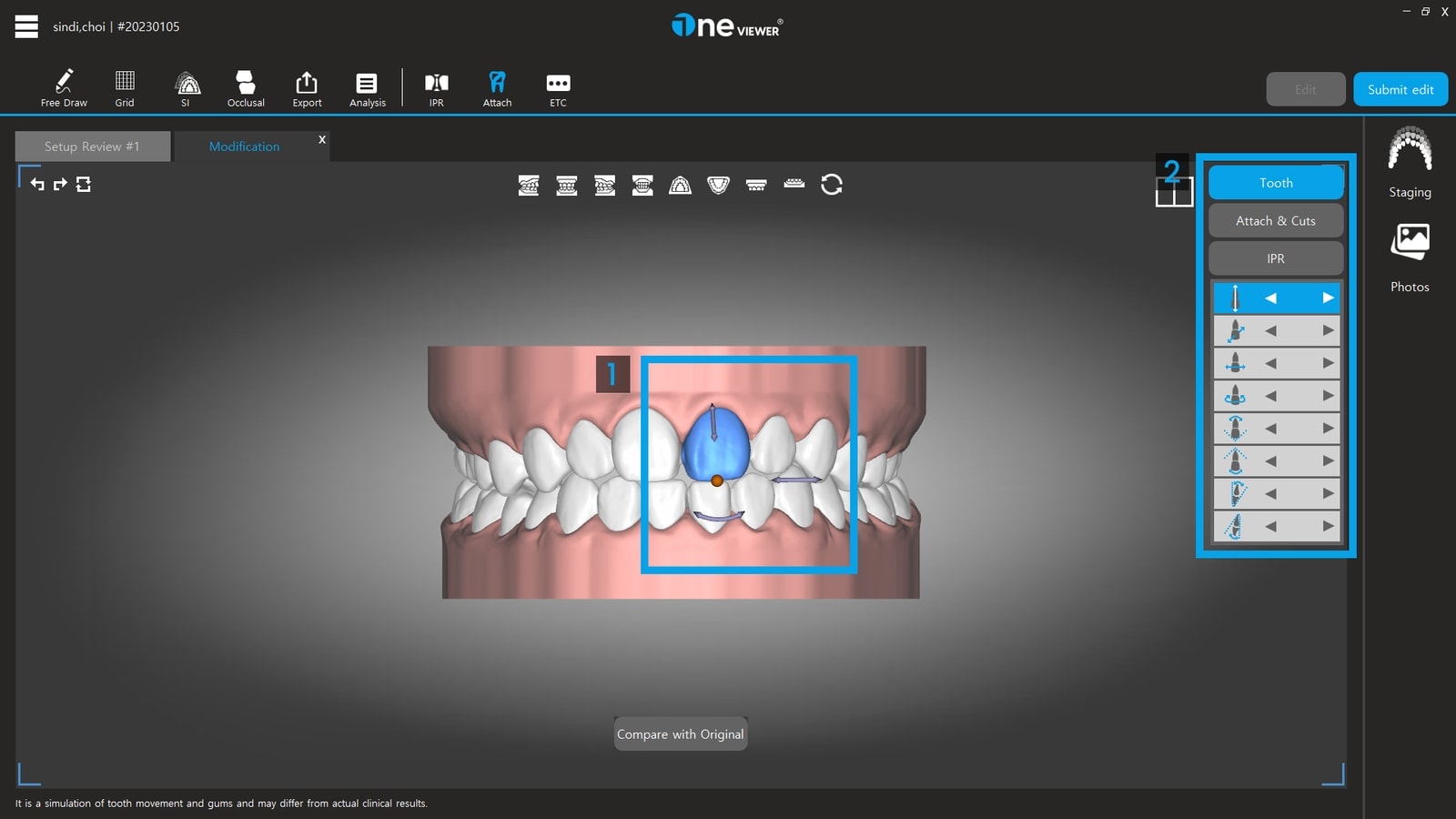 Tooth edit screen